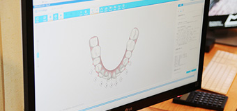 インビザラインの特徴～装置の比較～