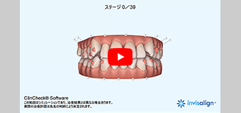 step4 歯の移動シミュレーション